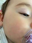 Сыпь на лице у ребенка 9 месяцев фото 2