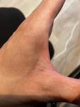 Сыпь между большим и указательном пальце на изгибе левой руки фото 2