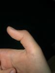 Травма великого пальця руки фото 2
