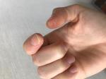 Трещины на коже, утолщение под ногтями пальцев рук фото 1