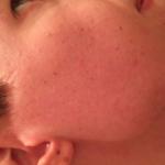 Появилась как красная сыпь фото 2