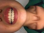 Ассиметрия лица, неправильный прикус, удаление зуба мудрости фото 3