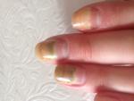 Отслойка ногтевой пластины от пальца фото 1