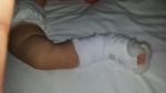 Сломана малая берцовая кость у ребенка 11 месяцев фото 2