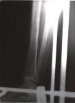 Перелом большеберцовой кости фото 1