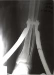 Перелом большеберцовой кости фото 2