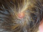 Розовое образование на волосистой части головы фото 1
