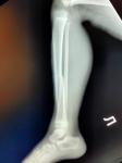 Перелом большой берцовой кости у ребенка 5 лет фото 1