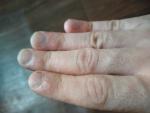 Сыпь на ладонях и пальцах рук фото 2