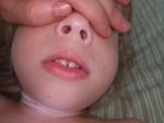 В носовых проходах ребенка шарики или воспаленная слизистая фото 1