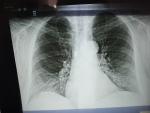Рентген снимок кашель фото 1