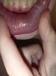 Налет на языке, и белая клякса на нижней губе фото 3