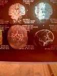 Аневризма головного мозга левой ВСА фото 3