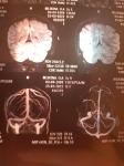 Аневризма головного мозга левой ВСА фото 2