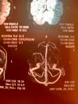 Аневризма головного мозга левой ВСА фото 1