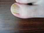 Продольные трещины на ногтях фото 1