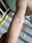 Прыщи на руках у ребенка от укусов комаров.? фото 1