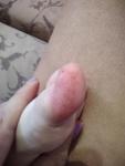 Покраснения на пальцах ног у ребенка, безболезненные, небольшой зуд фото 1