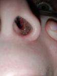 Болит внутри носа фото 1