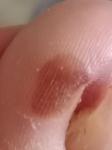 Коричневое пятно на пальце ноги фото 2