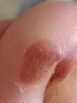 Коричневое пятно на пальце ноги фото 3
