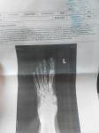 Остеоартроз большого пальца левой стопы фото 1