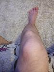 Опухоль колена фото 3