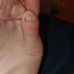 Болят ногти мизинцев ногтей фото 1