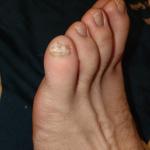 Болят ногти мизинцев ногтей фото 2