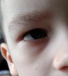 Бесцветная сыпь под глазом фото 4