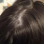 Перхоть или нет фото 1