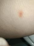 Пятно на внутренней стороне бедра без зуда фото 3