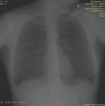 Рентген легких - результат по прилагаемому снимку фото 1
