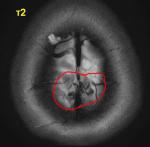 МРТ головного мозга, помогите разобраться (седло, сосудистая патология и инфаркт) фото 3