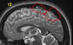 МРТ головного мозга, помогите разобраться (седло, сосудистая патология и инфаркт) фото 4