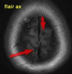 МРТ головного мозга, помогите разобраться (седло, сосудистая патология и инфаркт) фото 5
