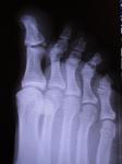 После травма пальца на ноге образовалась гематома, жар при ходьбе фото 2