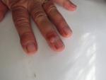 Полупрозрачная шишка возле ногтя на пальце руки фото 2