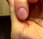 Белые пятнышки на ногте фото 1