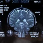 Що то за біла пляма на МРТ головного мозку фото 1