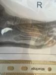 Закрытый перелом основания 5 плюсневой кости правой стопы без смещения фото 3