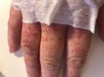 Сыпь на руке после антибиотиков фото 1