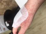 Сыпь на руке после антибиотиков фото 2