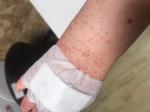 Сыпь на руке после антибиотиков фото 3