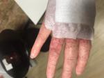 Сыпь на руке после антибиотиков фото 4