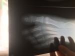 Сложный перелом второго пальца левой ноги фото 3