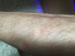 Красные пятна на коже (преимущественно ноги (бедра) фото 4