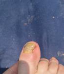 Шишка под ногтем на ноге фото 2
