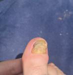 Шишка под ногтем на ноге фото 3