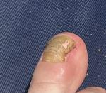 Шишка под ногтем на ноге фото 1